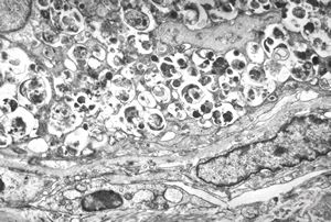 F,40y. | granular cell tumor - larynx F,40y. | granular cell tumor - larynx